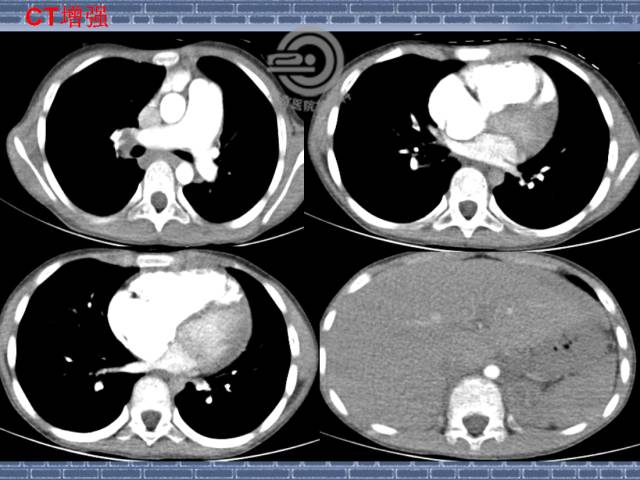 【病例】肺静脉闭塞性疾病1例CT影像表现