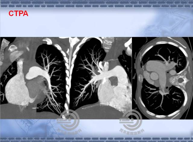 【病例】肺静脉闭塞性疾病1例CT影像表现