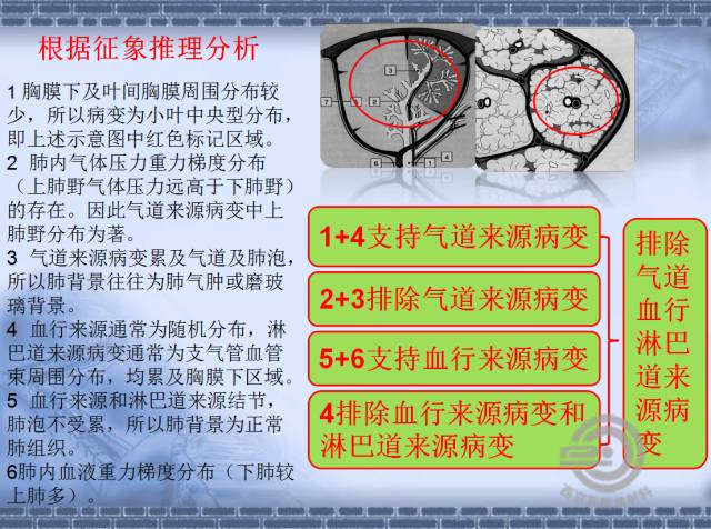 【病例】肺静脉闭塞性疾病1例CT影像表现