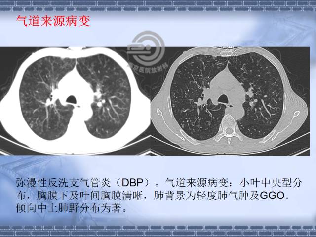 【病例】肺静脉闭塞性疾病1例CT影像表现