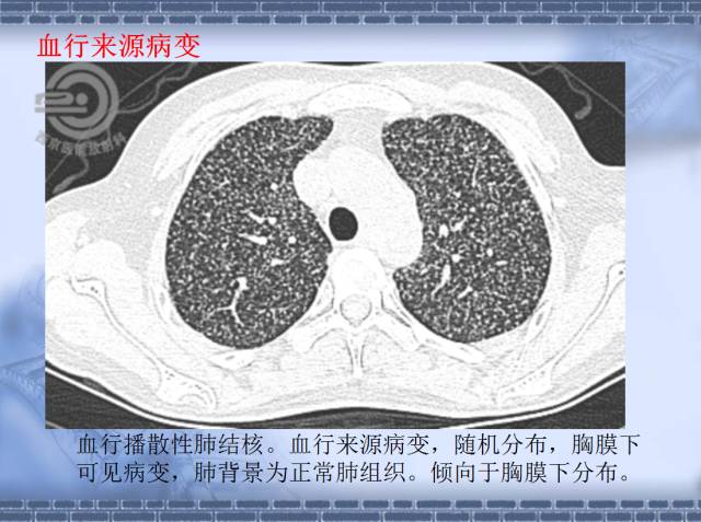 【病例】肺静脉闭塞性疾病1例CT影像表现