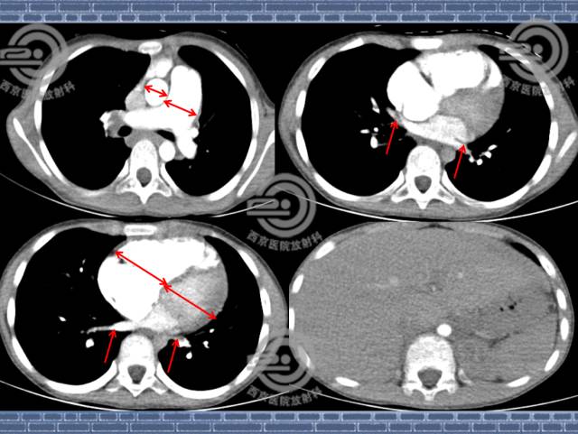 【病例】肺静脉闭塞性疾病1例CT影像表现