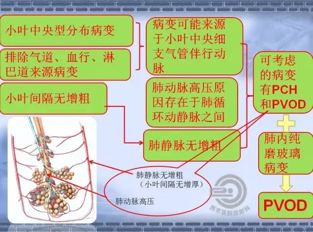 【病例】肺静脉闭塞性疾病1例CT影像表现