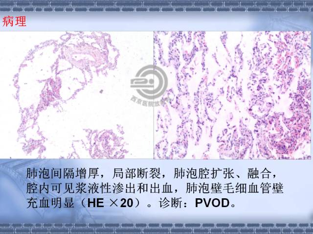【病例】肺静脉闭塞性疾病1例CT影像表现