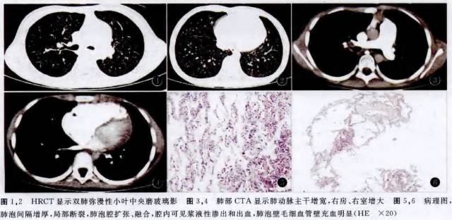 【病例】肺静脉闭塞性疾病1例CT影像表现