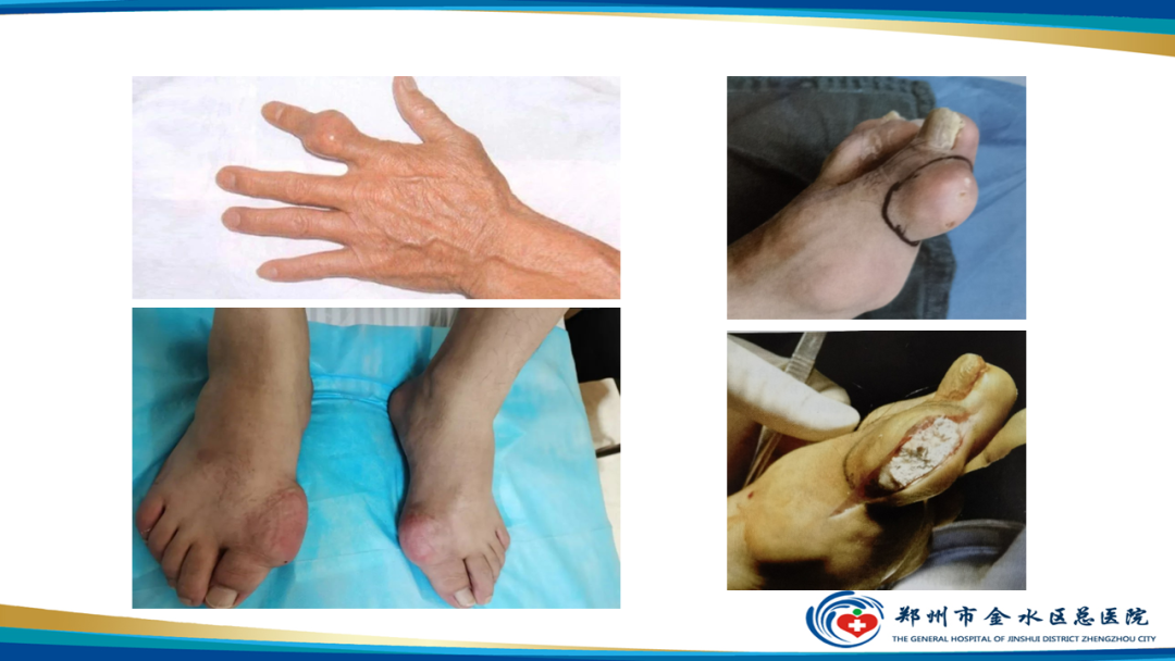 【PPT】痛风的影像诊断及鉴别诊断-8