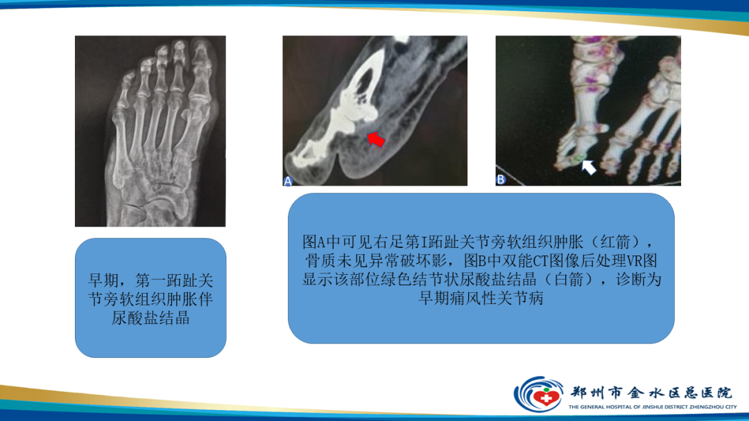 【PPT】痛风的影像诊断及鉴别诊断-10