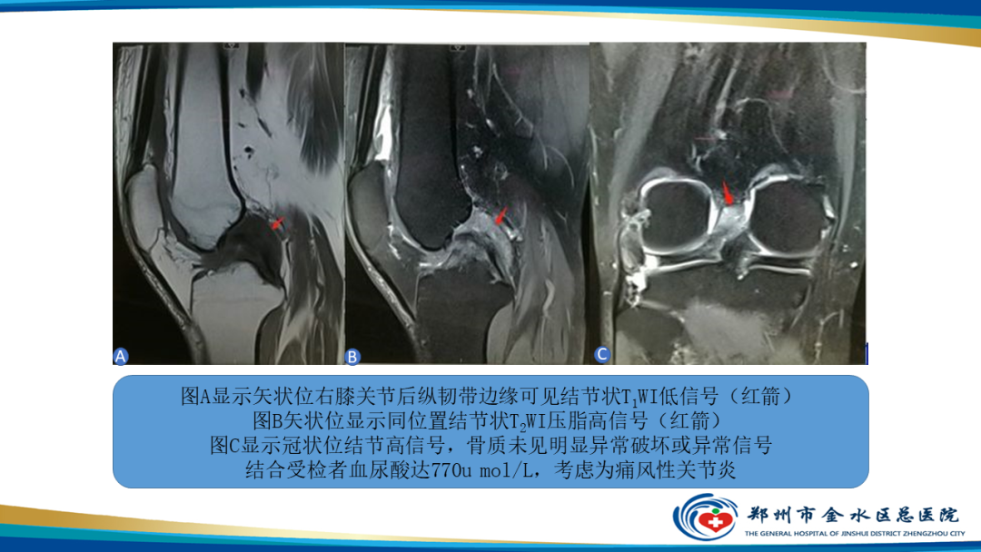 【PPT】痛风的影像诊断及鉴别诊断-11