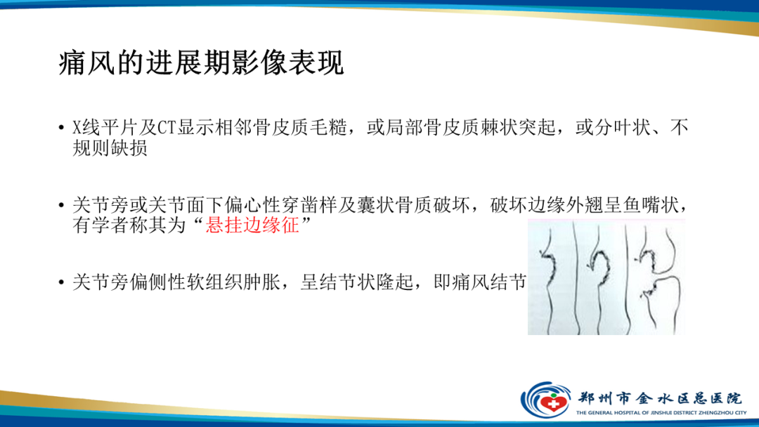 【PPT】痛风的影像诊断及鉴别诊断-12