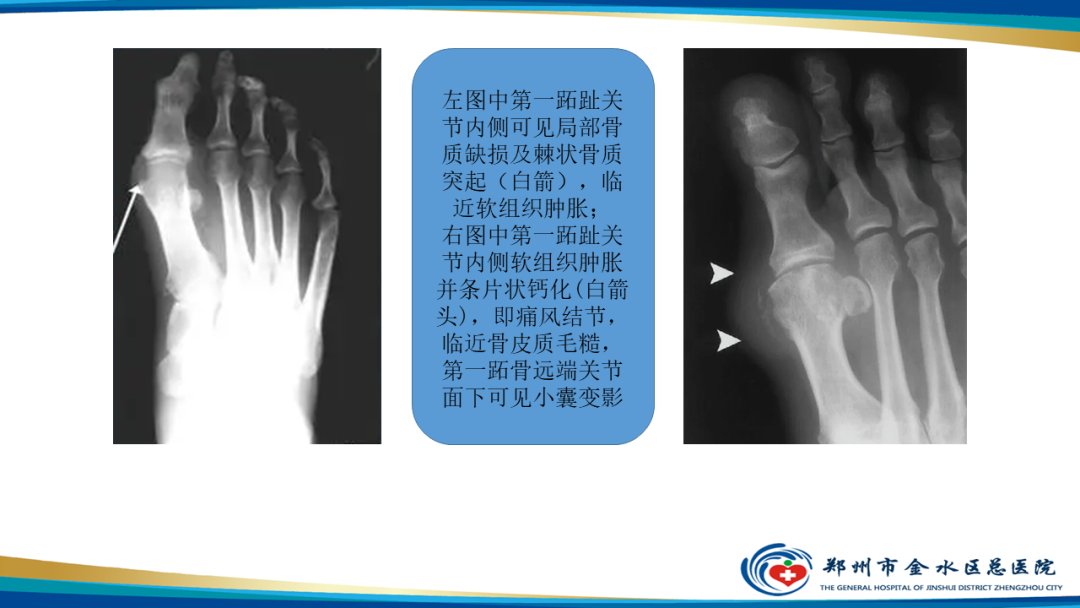 【PPT】痛风的影像诊断及鉴别诊断-14