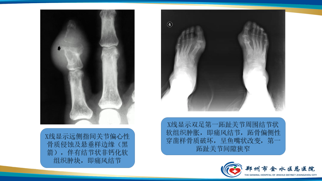 【PPT】痛风的影像诊断及鉴别诊断-15
