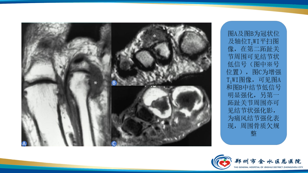 【PPT】痛风的影像诊断及鉴别诊断-18