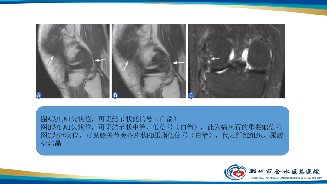 【PPT】痛风的影像诊断及鉴别诊断-19