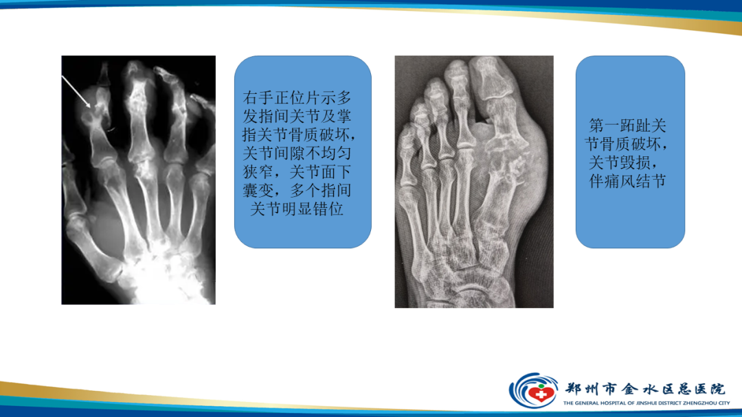 【PPT】痛风的影像诊断及鉴别诊断-21