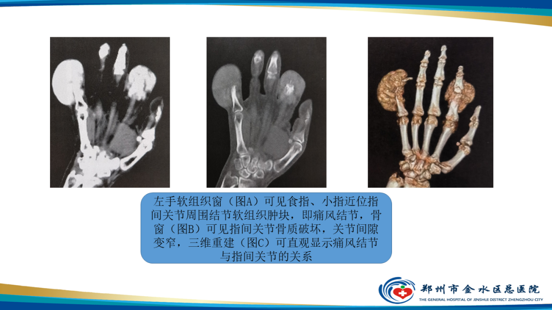 【PPT】痛风的影像诊断及鉴别诊断-22