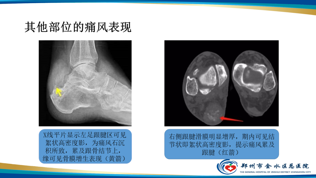 【PPT】痛风的影像诊断及鉴别诊断-23