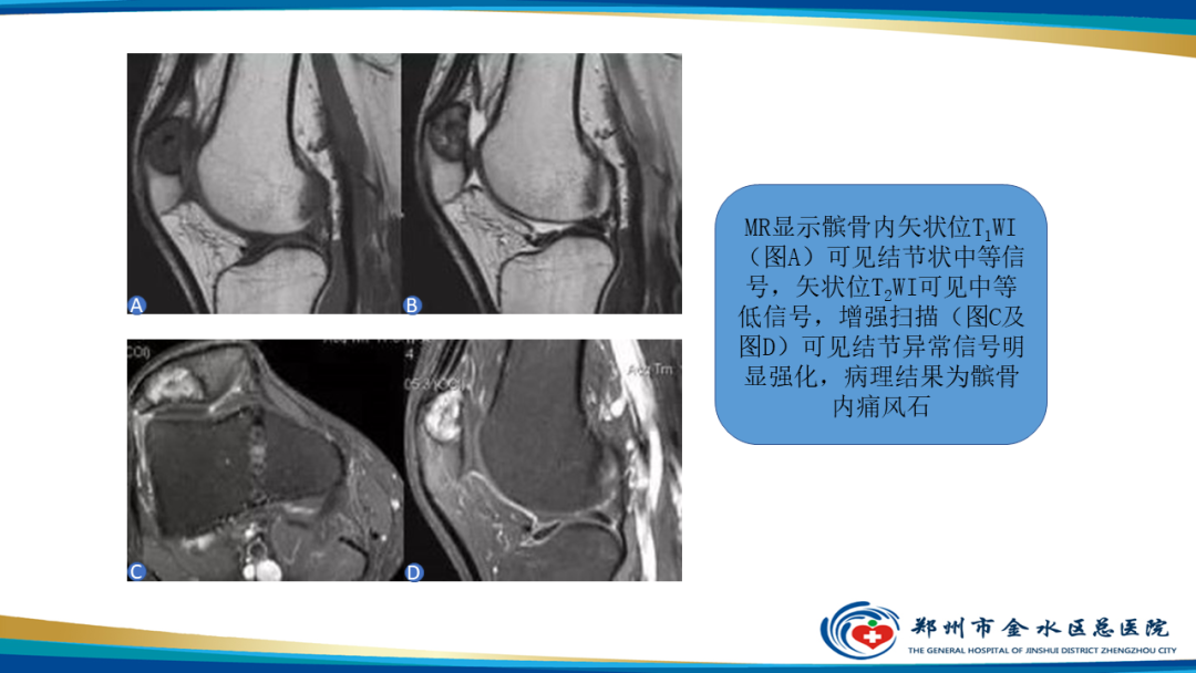 【PPT】痛风的影像诊断及鉴别诊断-24
