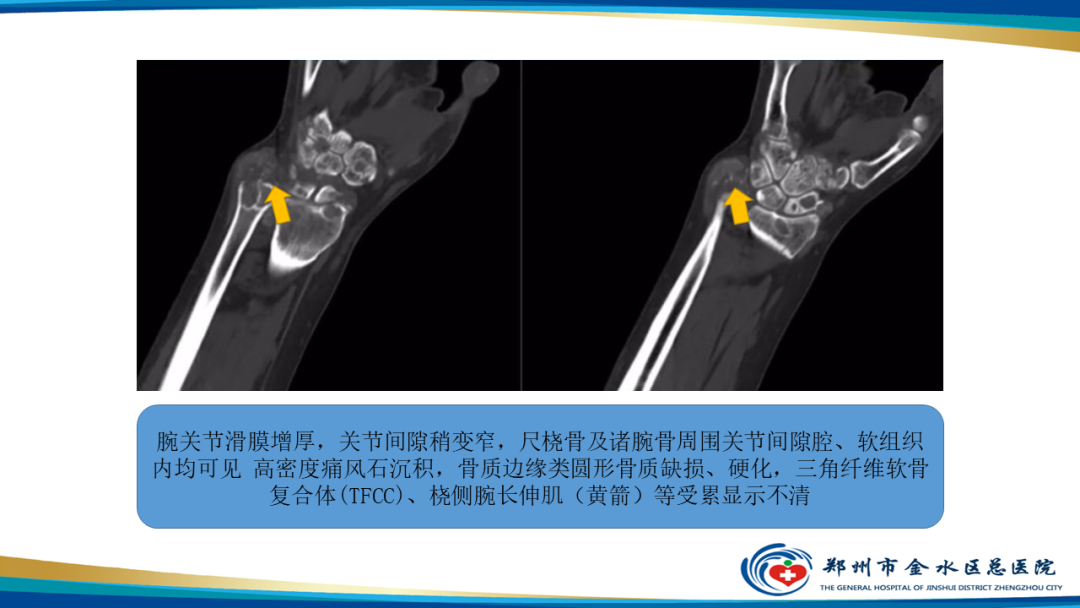 【PPT】痛风的影像诊断及鉴别诊断-25
