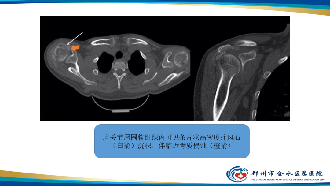 【PPT】痛风的影像诊断及鉴别诊断-26