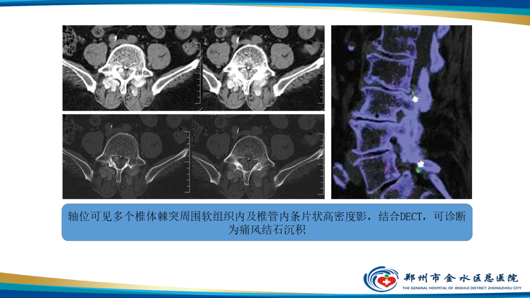 【PPT】痛风的影像诊断及鉴别诊断-27