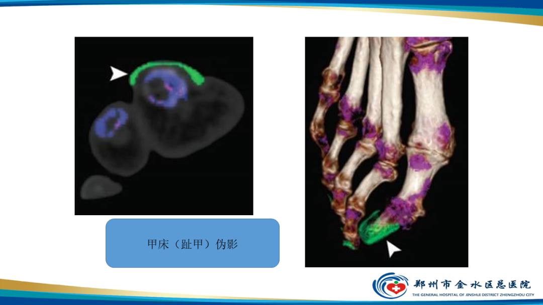 【PPT】痛风的影像诊断及鉴别诊断-29