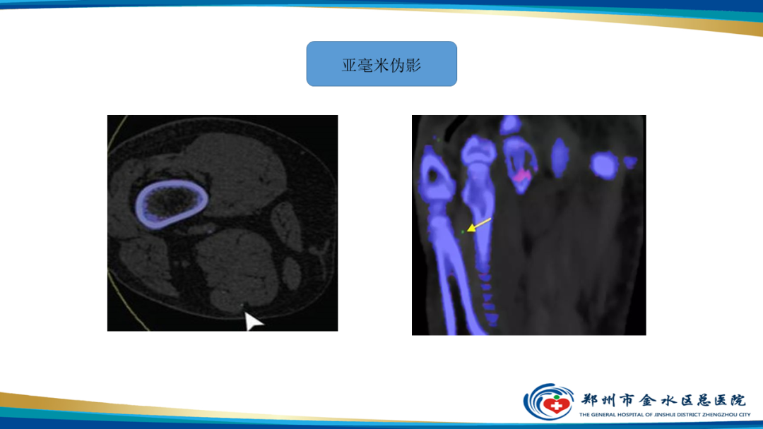 【PPT】痛风的影像诊断及鉴别诊断-31