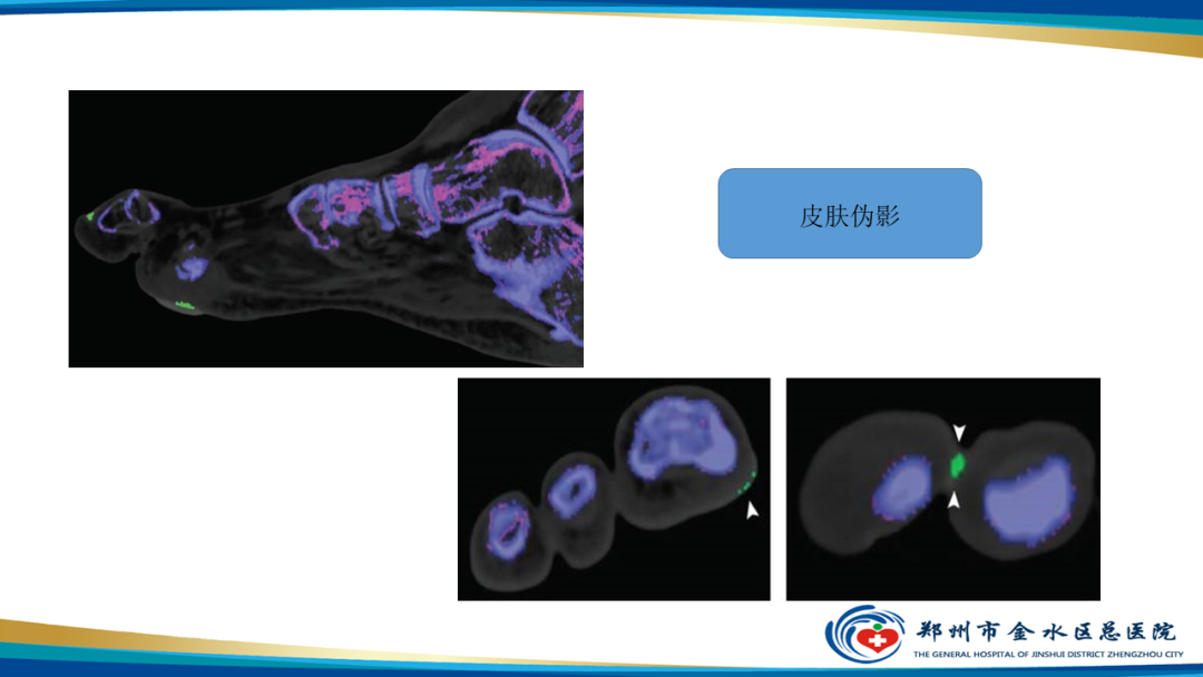【PPT】痛风的影像诊断及鉴别诊断-30