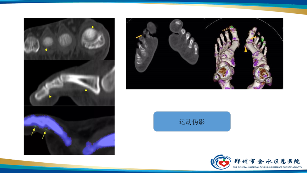 【PPT】痛风的影像诊断及鉴别诊断-32