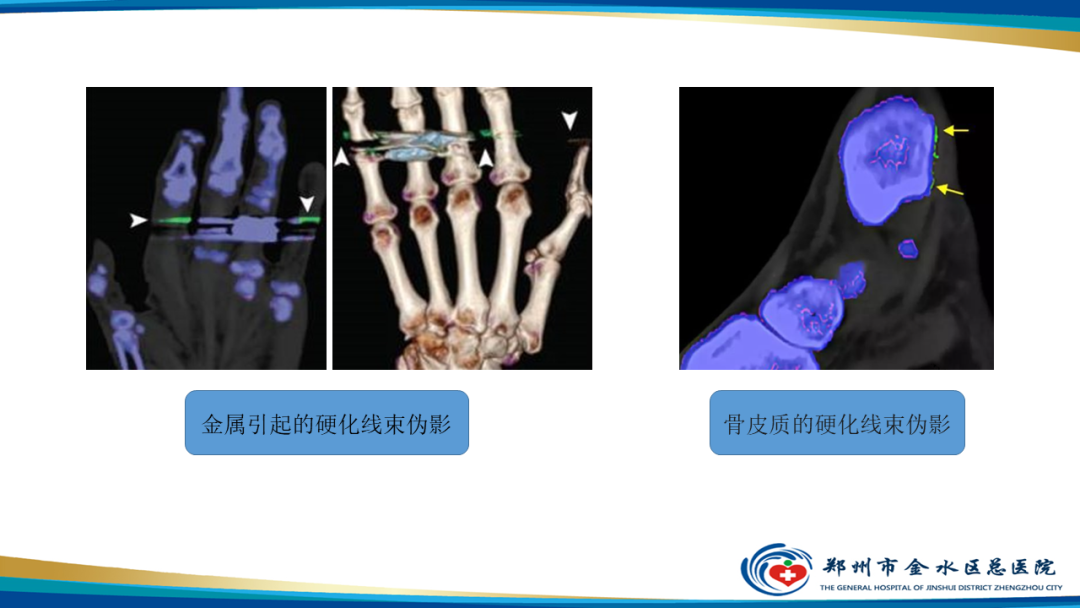 【PPT】痛风的影像诊断及鉴别诊断-34