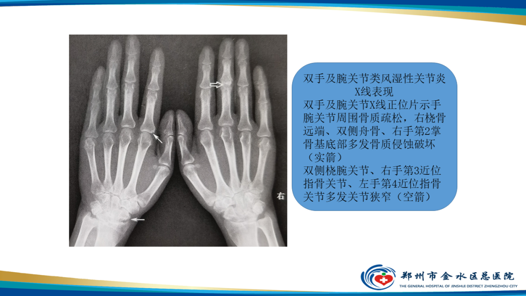 【PPT】痛风的影像诊断及鉴别诊断-37