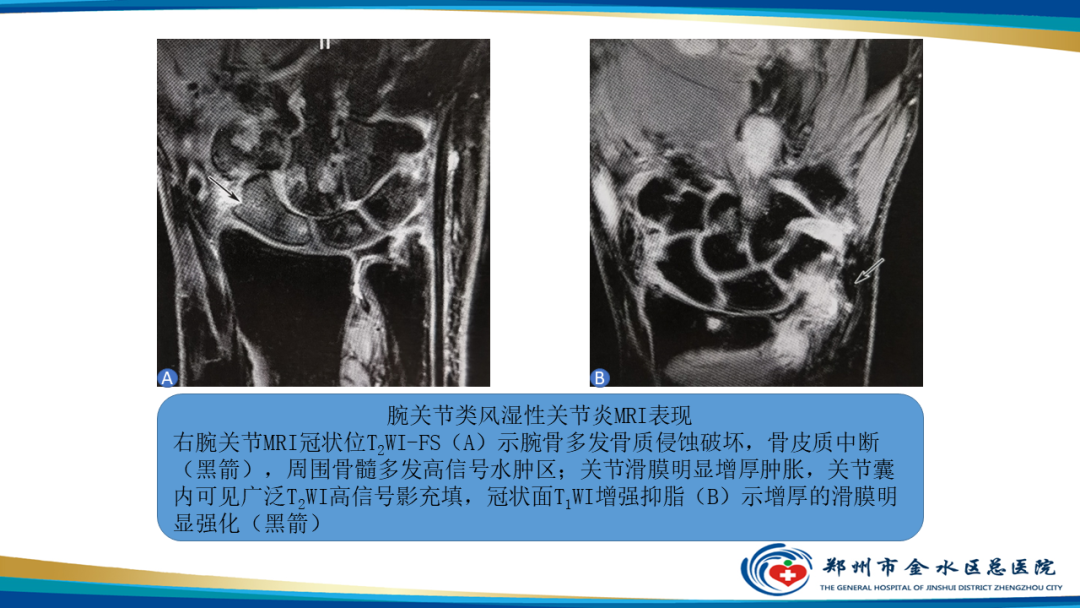 【PPT】痛风的影像诊断及鉴别诊断-38