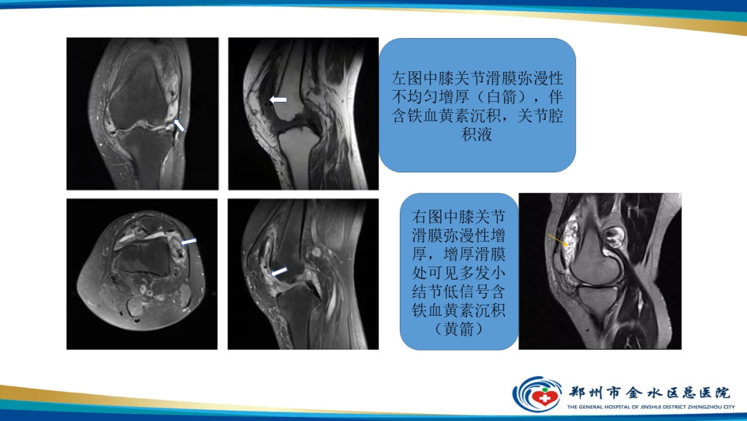 【PPT】痛风的影像诊断及鉴别诊断-43