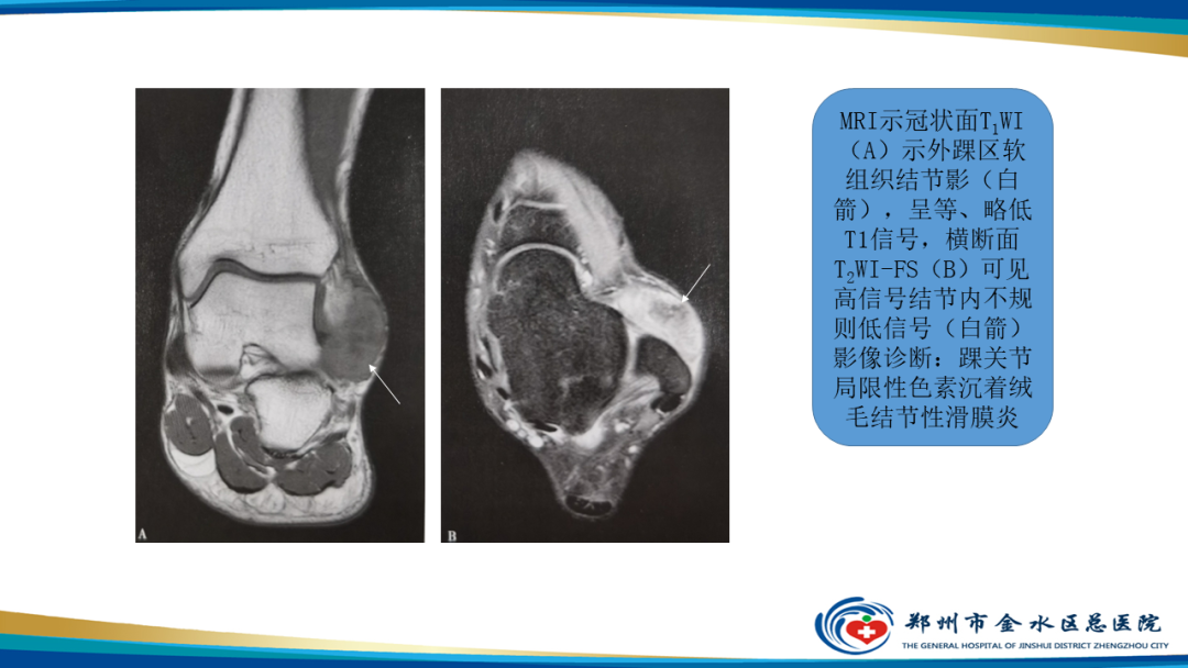 【PPT】痛风的影像诊断及鉴别诊断-44