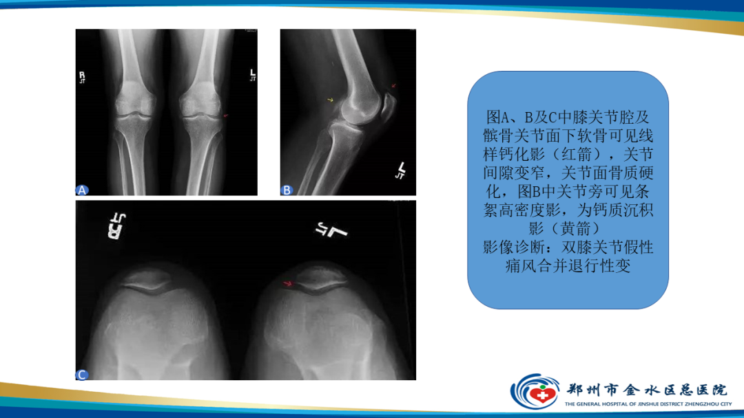 【PPT】痛风的影像诊断及鉴别诊断-46