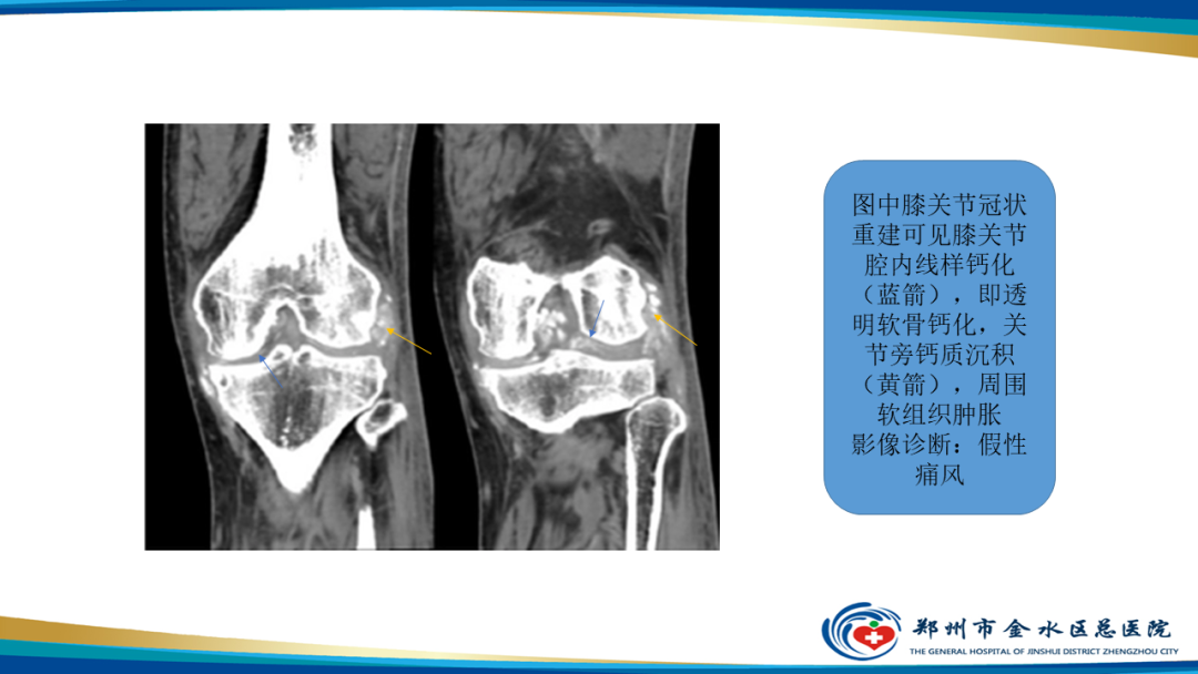 【PPT】痛风的影像诊断及鉴别诊断-47