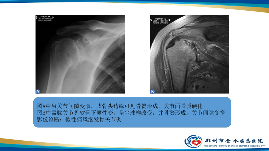 【PPT】痛风的影像诊断及鉴别诊断-48
