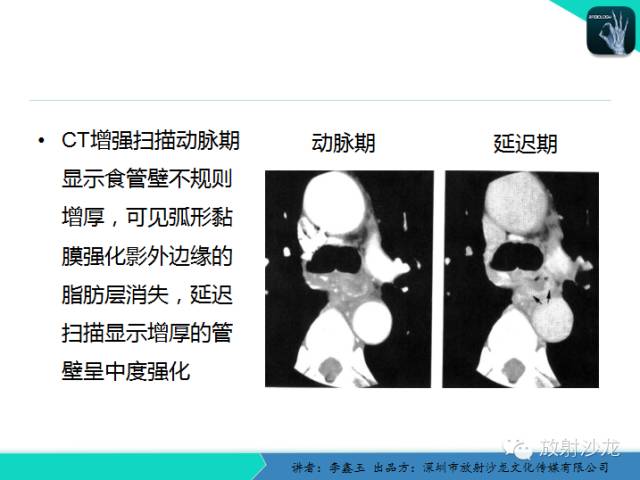 【原创】CT在食管癌诊疗中的应用