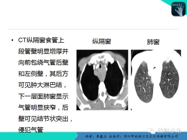 【原创】CT在食管癌诊疗中的应用