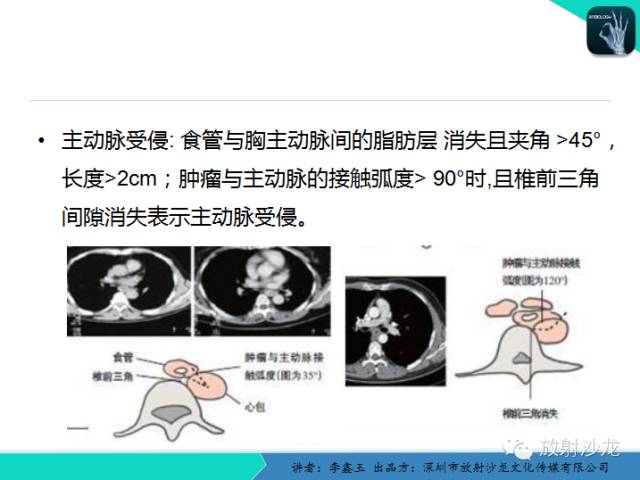 【原创】CT在食管癌诊疗中的应用