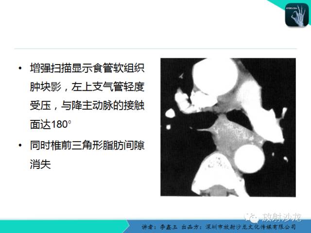 【原创】CT在食管癌诊疗中的应用