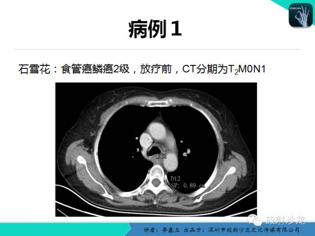 【原创】CT在食管癌诊疗中的应用