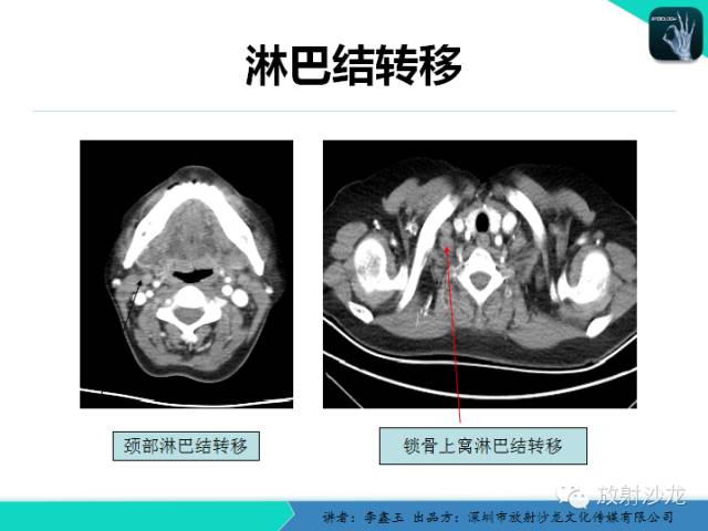 【原创】CT在食管癌诊疗中的应用
