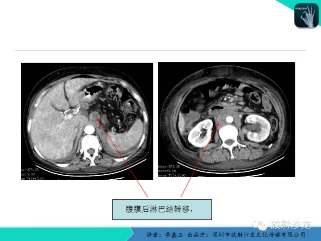 【原创】CT在食管癌诊疗中的应用