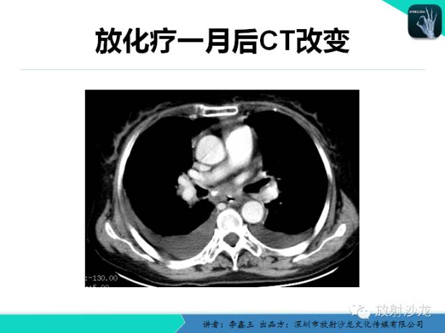 【原创】CT在食管癌诊疗中的应用
