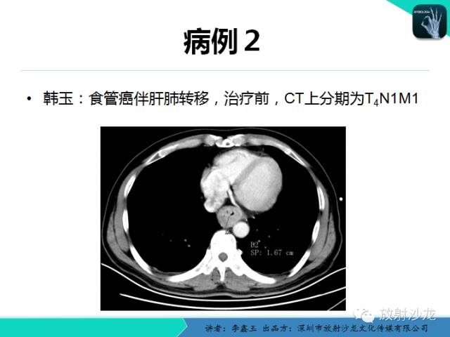 【原创】CT在食管癌诊疗中的应用