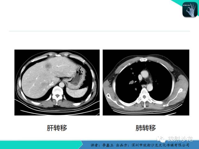 【原创】CT在食管癌诊疗中的应用
