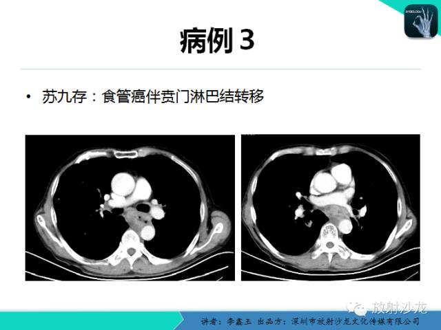 【原创】CT在食管癌诊疗中的应用