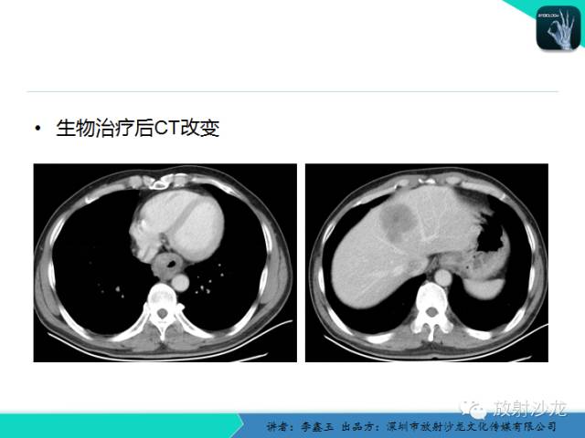 【原创】CT在食管癌诊疗中的应用