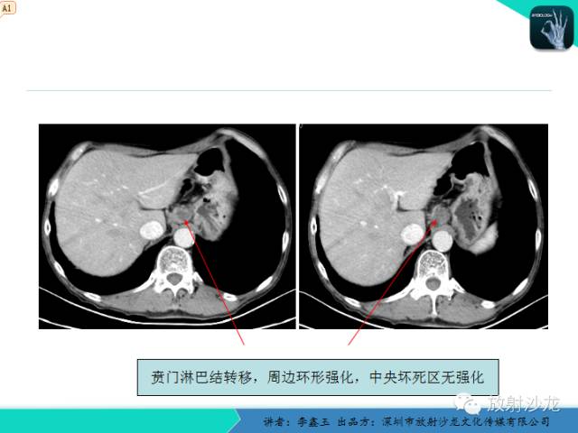 【原创】CT在食管癌诊疗中的应用