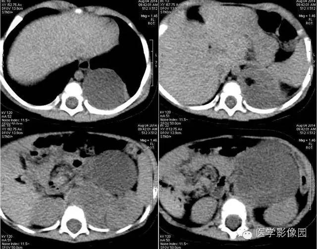 【病例】腹膜后畸胎瘤1例CT影像表现